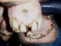 Horse Teeth Extraction 2